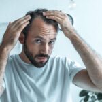 Alopecia androgenetica a seguito di un tumore testicolare: come intervenire con sicurezza