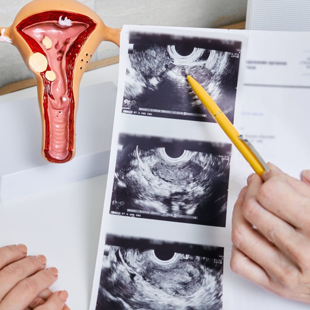 Sindrome metabolica e tumore dell’endometrio: impatto sistemico e conseguenze anche sulla salute dei capelli